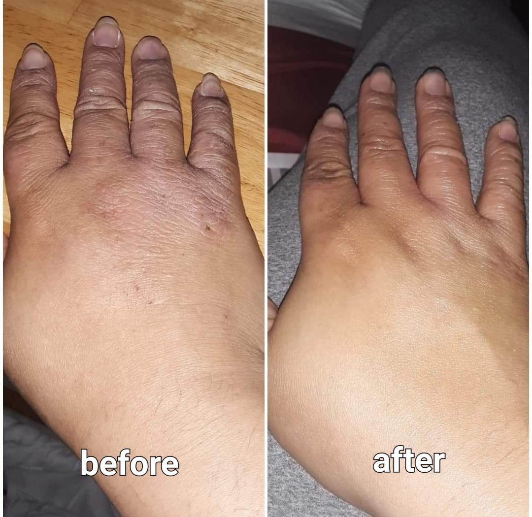 Before and after pic of Eczema on hand