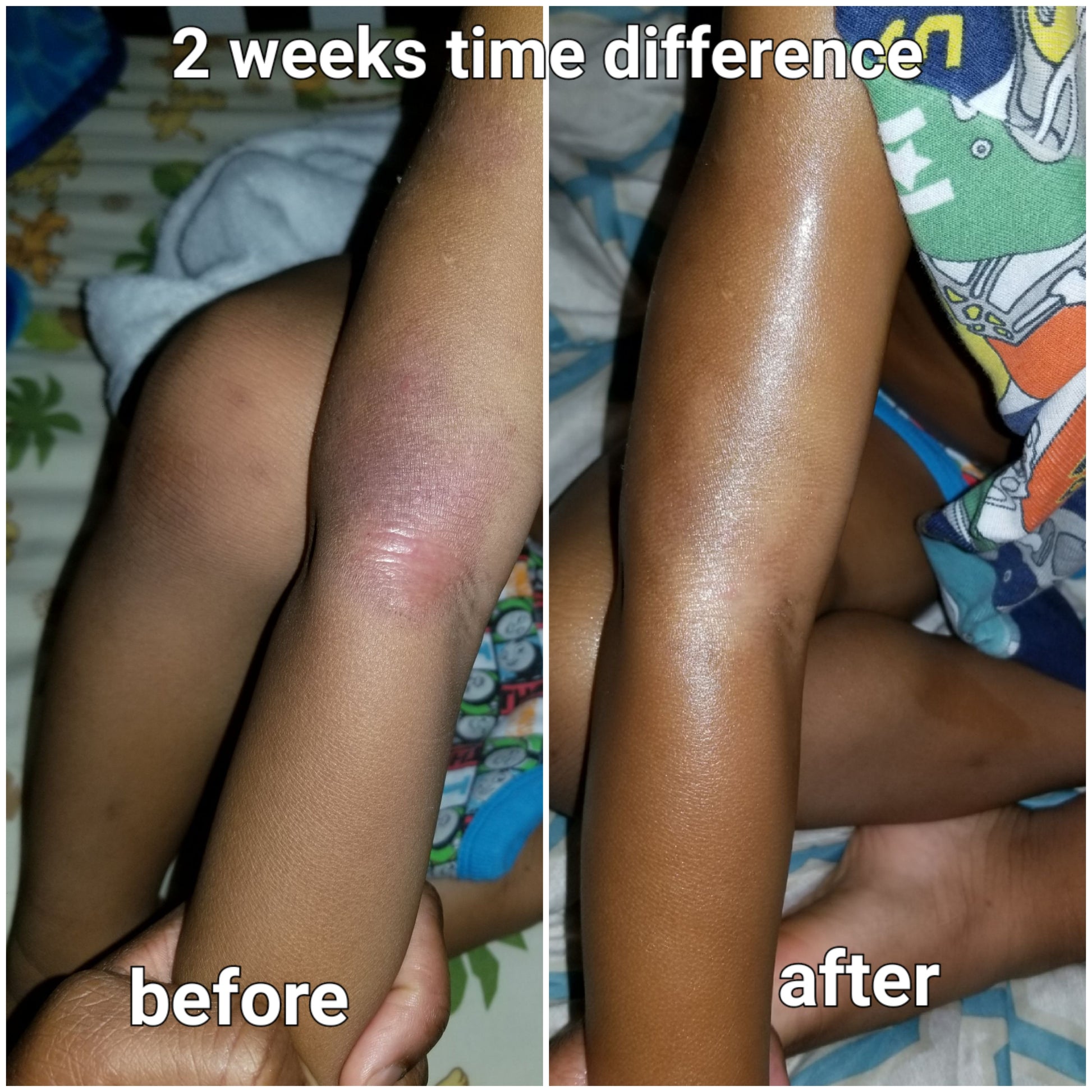 Before and after pic of eczema on a child arm